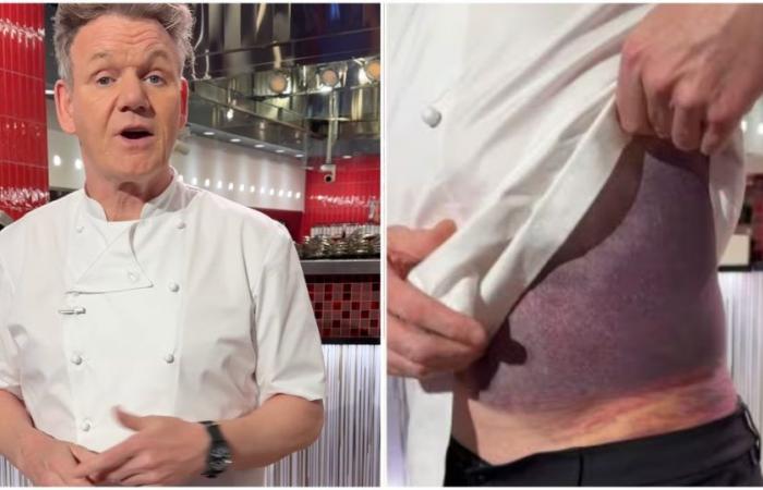 Accident for Gordon Ramsay, the chef shows bruises and says: “Lucky to still be alive, I look like a purple potato”