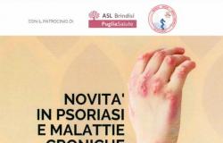 “Psoriasis and new therapies”: discussion in Brindisi with national experts – Pugliapress