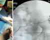 Potenza Hospital. Latest generation implants to eliminate pain with sacral stimulation – Ondanews.it
