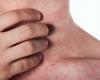 These signs on the skin indicate a very serious zinc deficiency: it is better to take action immediately