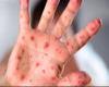Measles. Alarm in Rimini, cases on the rise. From today free vaccination in Romagna